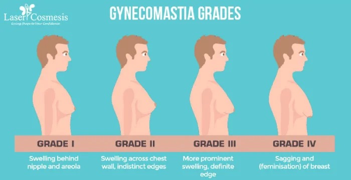 What is Gynecomastia Surgery